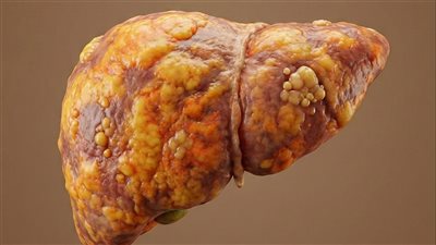 تغيرات محددة في الأظافر قد تشير إلى الإصابة بمرض الكبد الدهني