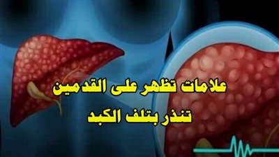 ثلاث علامات على القدمين قد تشير إلى خطر الإصابة بمرض الكبد الدهني